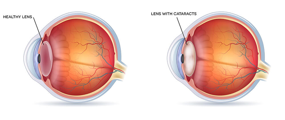 Chart Showing a Healthy Eye Compared to One With a Cataract