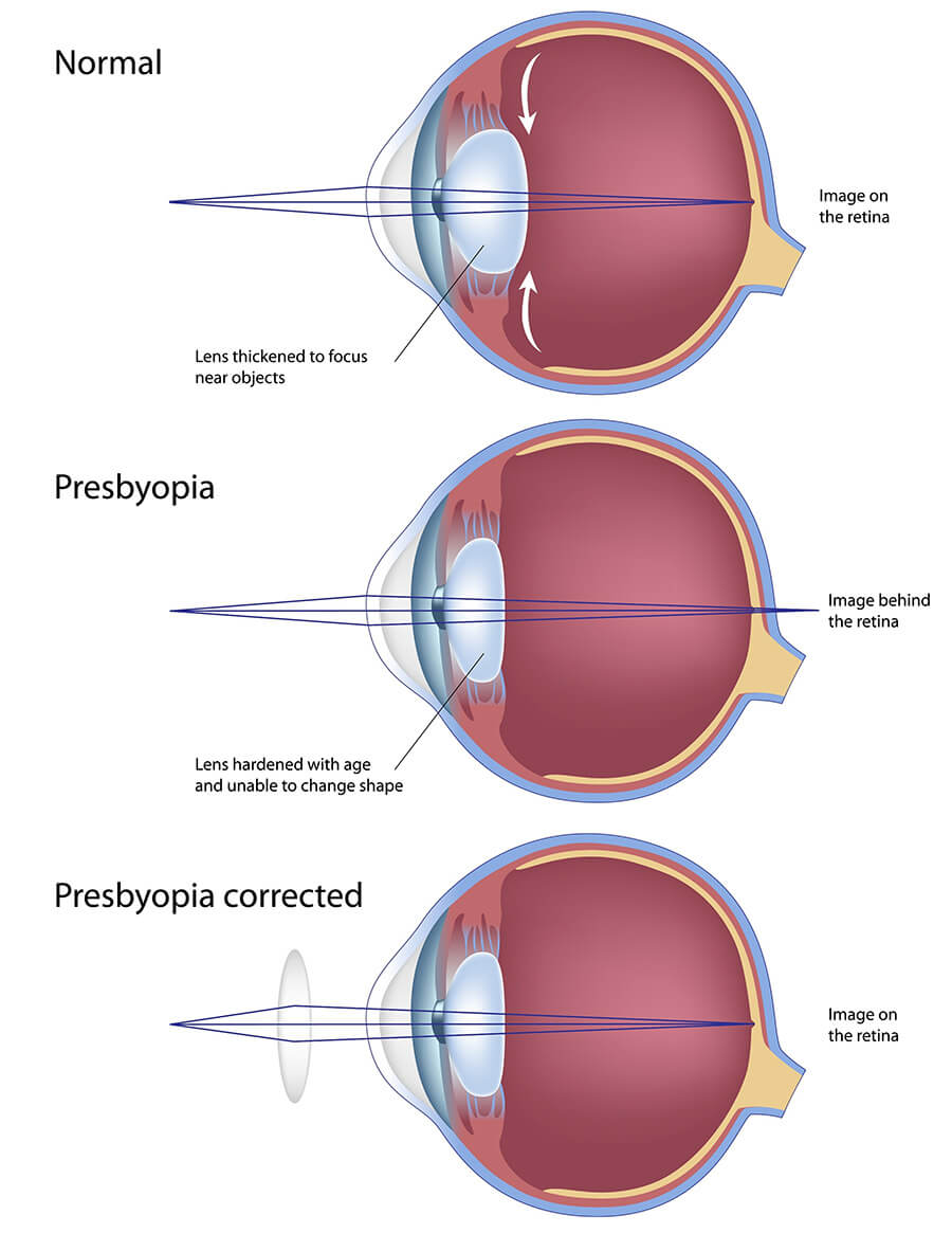 Chart Showing How Presbyopia Affects the Eye